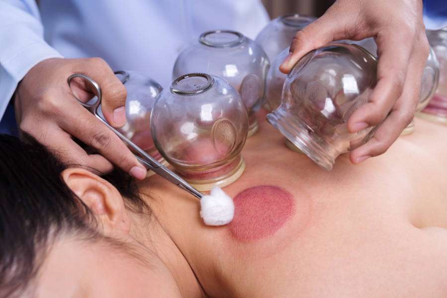 Cupping Therapy: Types, Benefits, and Uses
